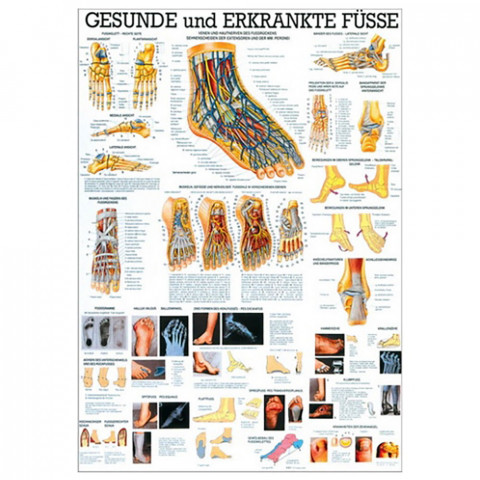 'Gesunde u. erkrankte Füße Lehrtafel 70 x 100 cm'